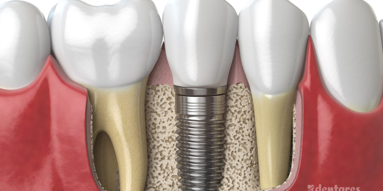 Dental implants in turkey 2024 price list