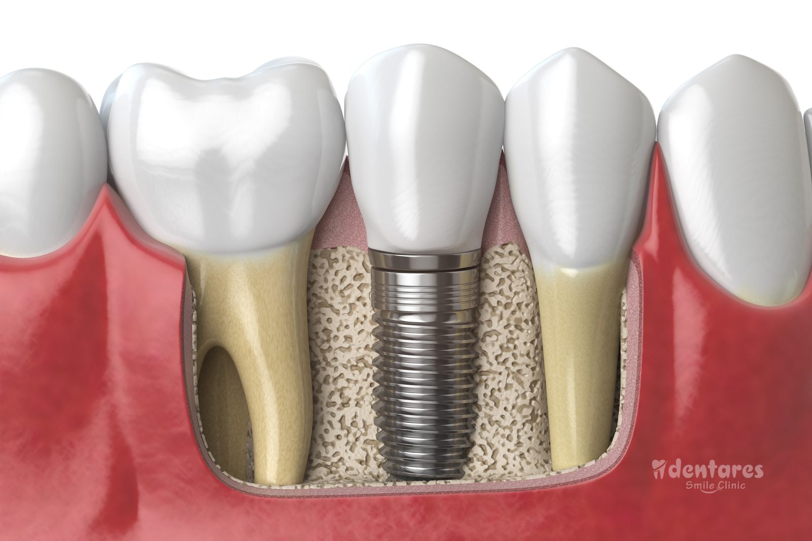 Dental implants in turkey, are biocompatible screws that are the best solution for restoring an edentulous area without using the support of your natural teeth. Implants have the same anatomical effect as the lower surface of natural teeth.
