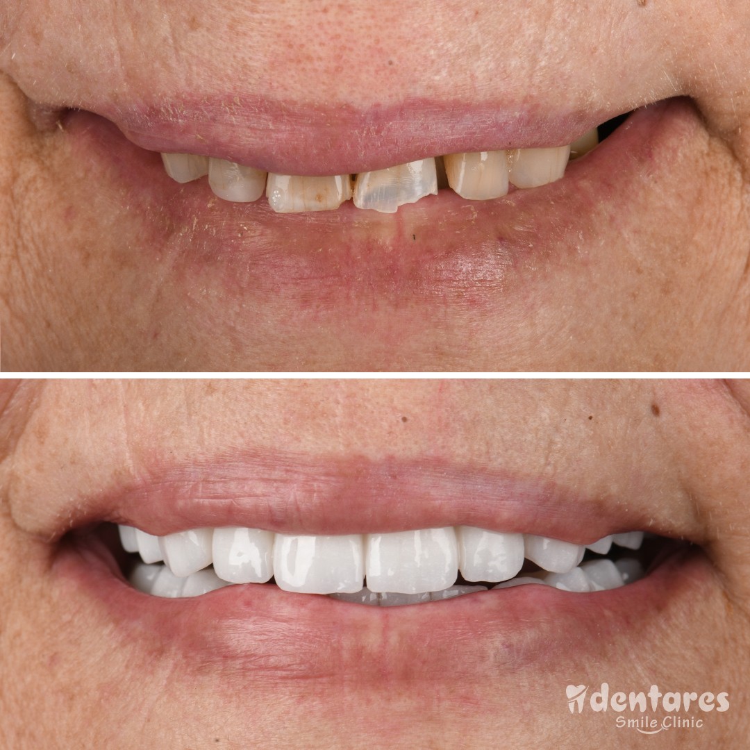 Discover Your Best Smile in Antalya: Before & After Gallery!