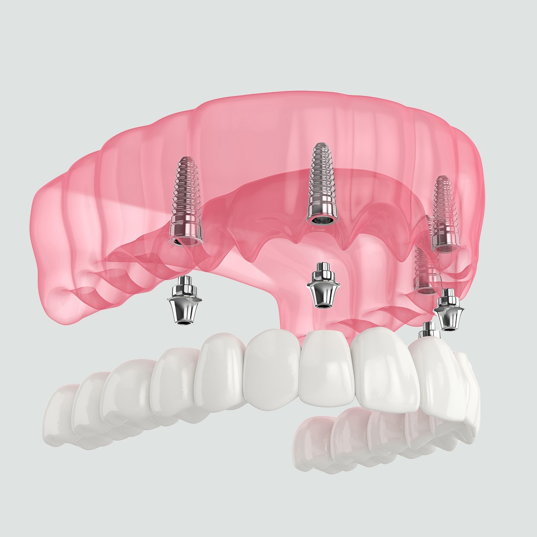 https://www.dentaressmile.co.uk/wp-content/uploads/2023/01/All-on-4-implants.jpg