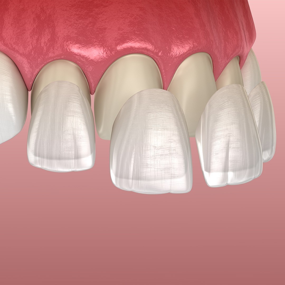 https://www.dentaressmile.co.uk/wp-content/uploads/2023/01/Dental-Lumineers2.jpg