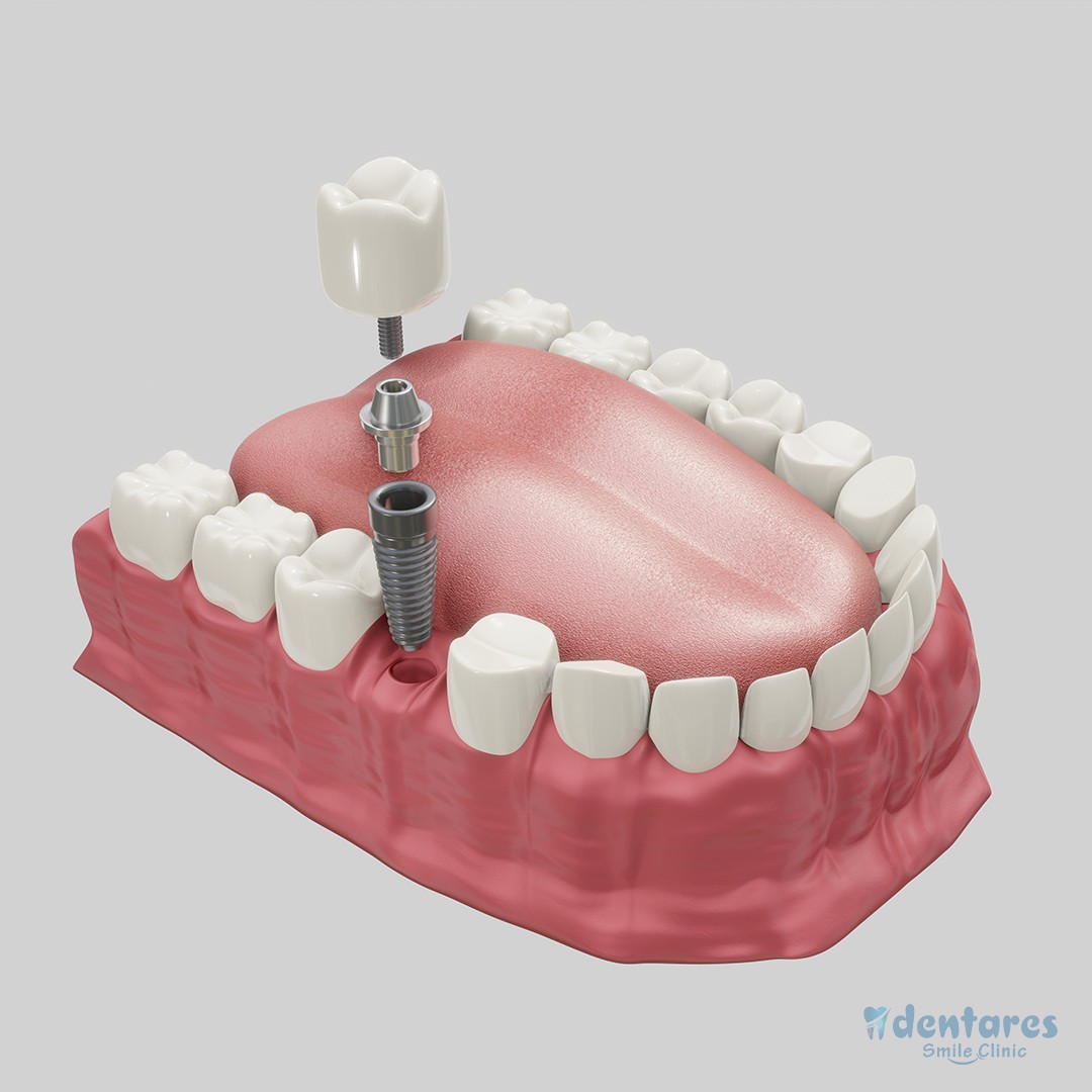 How Much Are Dental Implants In Turkey?